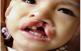How to deal with children born with physical deformities?