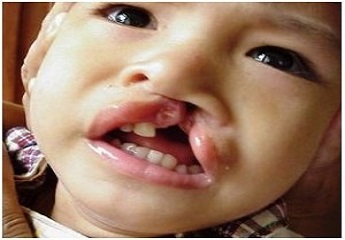 6 month old girl having cleft palate